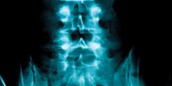 Scoliosis Treatment in Israel
